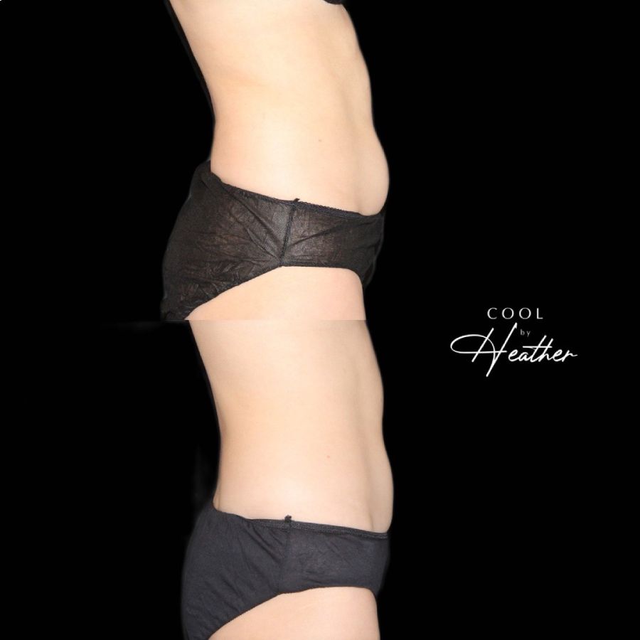 Before and after of a woman's body resulting to a more sculpted one from Coolsculpting, a service offered at Haus of Aesthetics in Salt Lake City, Utah.