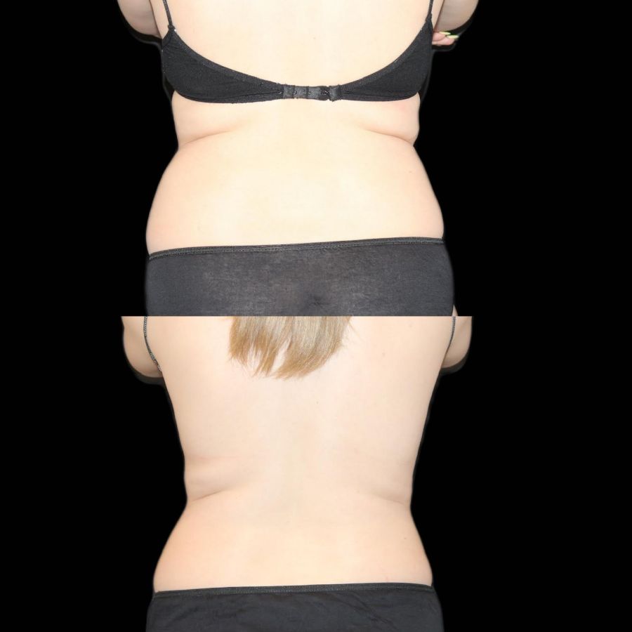 Before and after photo of a woman's hip that shows reduced fat from CoolSculpting treatment, a service offered at Haus of Aesthetics in Salt Lake City, Utah.