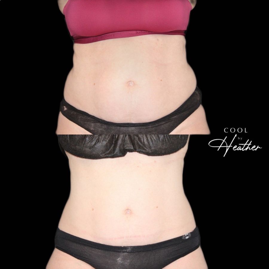 Before and after photo of a woman's belly that shows reduced fat from CoolSculpting treatment, a service offered at Haus of Aesthetics in Salt Lake City, Utah.