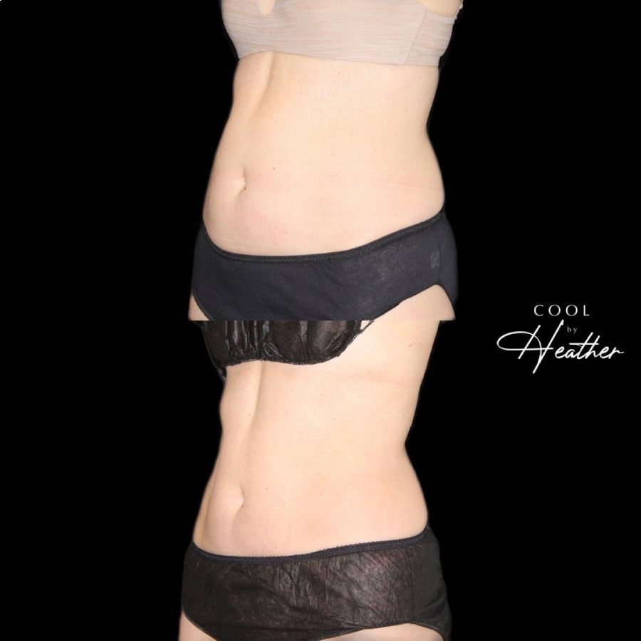 Comparison of a woman's stomach before and after Coolsculpting treatment, a service offered at Haus of Aesthetics in Salt Lake City, Utah.