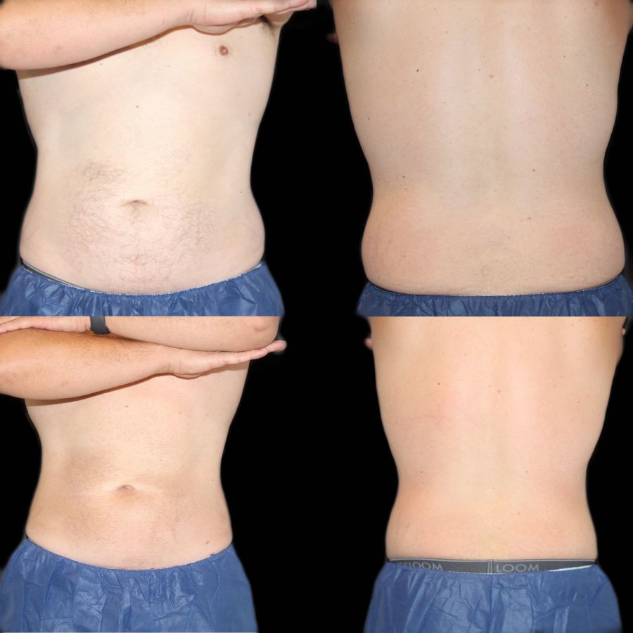 Before and after photos showing reduced fat in a man's belly area from Coolsculpting treatment, a service offered at Haus of Aesthetics in Salt Lake City, Utah.