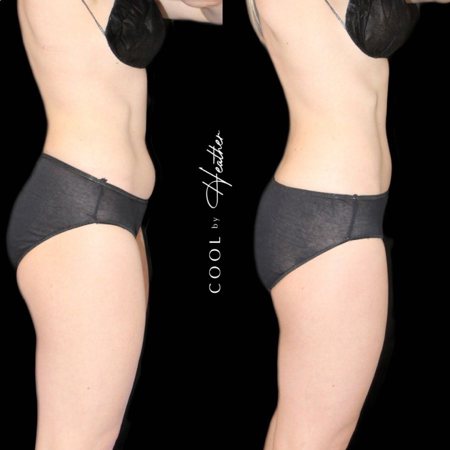 Coolsculpting Before and After of a woman's hip in Salt Lake City, Utah.