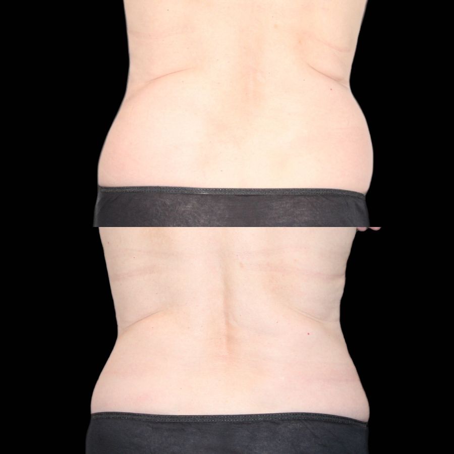 Before and after showing reduced bra fats from Coolsculpting treatment, a service offered at Haus of Aesthetics in Salt Lake City, Utah.