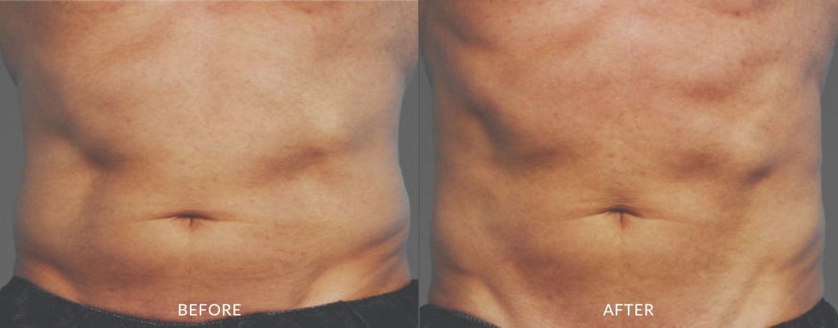 Before and after photos of a man's abdomen showing less muscle definition before and more sculpted, defined muscles after CoolTone treatment in Salt Lake City.