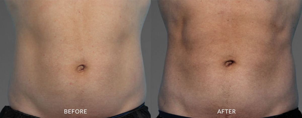 Before and after photos showing a man's abdomen with no muscle definition before and sculpted, toned, defined abs after CoolTone treatment in Utah.