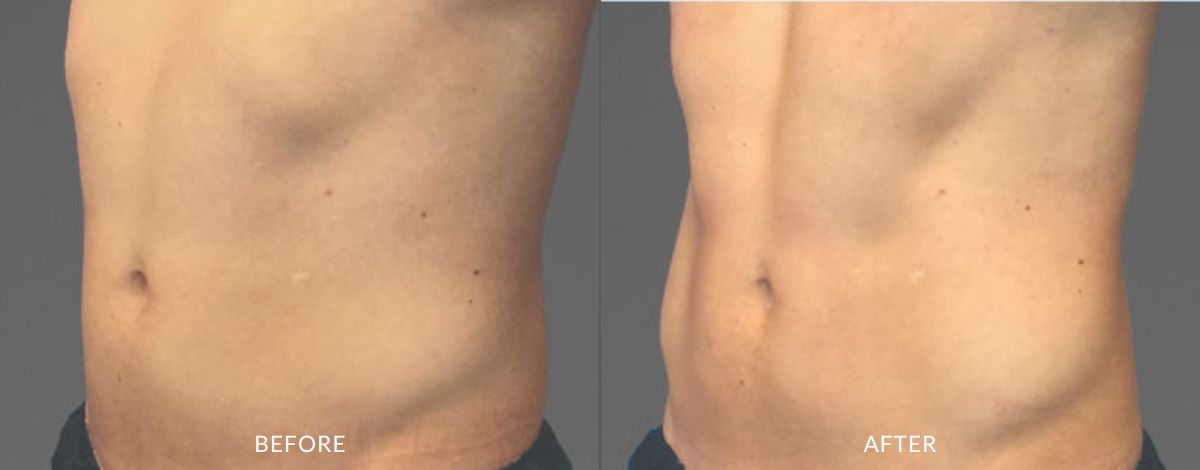 Before and after images showing the side view of a man's abdomen with little muscle definition before and more sculpted and defined muscles after CoolTone treatment in Salt Lake City, UT.