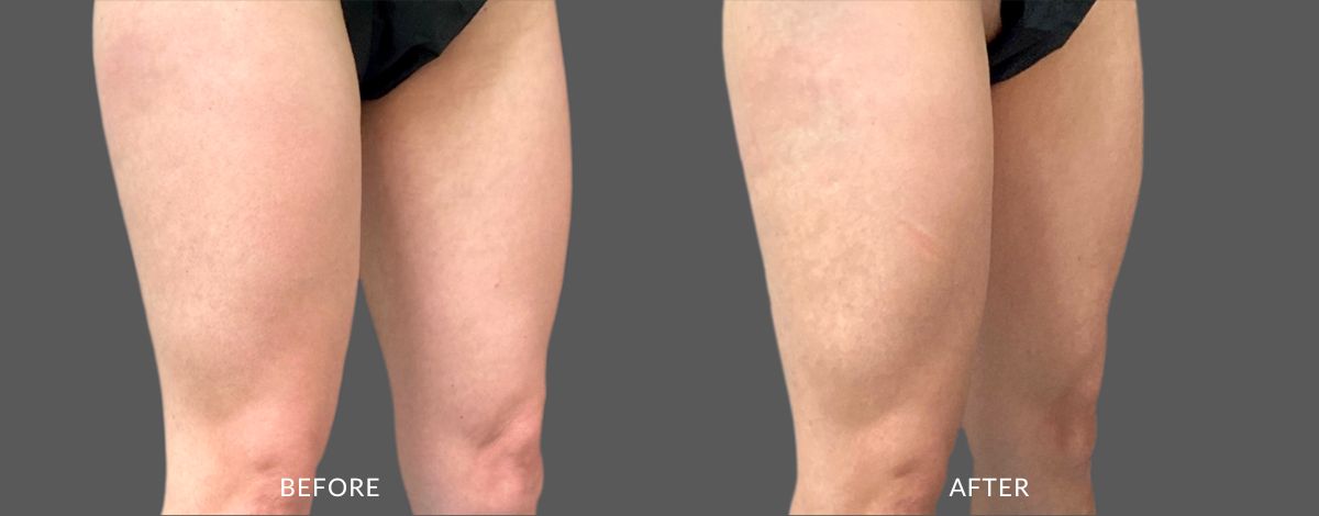 Before and after photos of a woman's thighs showing less muscle definition before and more defined sculpted muscles after CoolTone treatment in Utah.