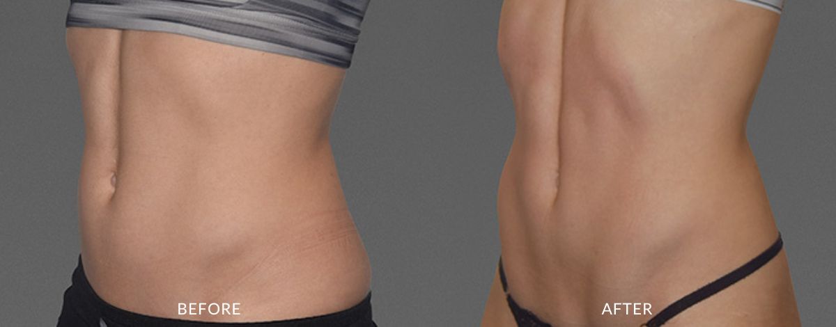 Before and after photos showing a woman's abdomen with less muscle definition before and flatter, leaner, more sculpted muscles after CoolTone treatment in Utah.