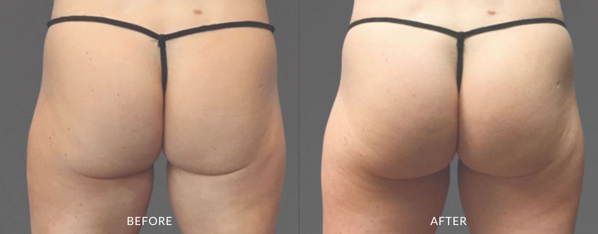 Before and after images showing a woman's buttocks looking flat before and bigger and more lifted after CoolTone treatment in Salt Lake City.