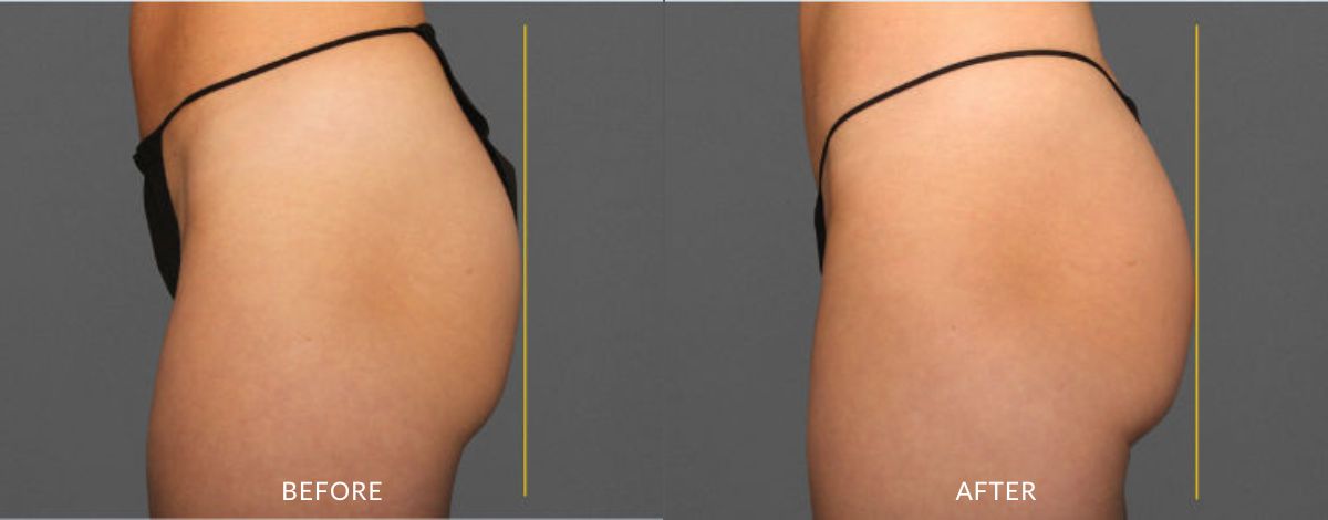 Before and after photos showing a woman's buttock with less muscle definition and looking smaller before and looking more lifted and muscular after CoolTone treatment in Salt Lake City.