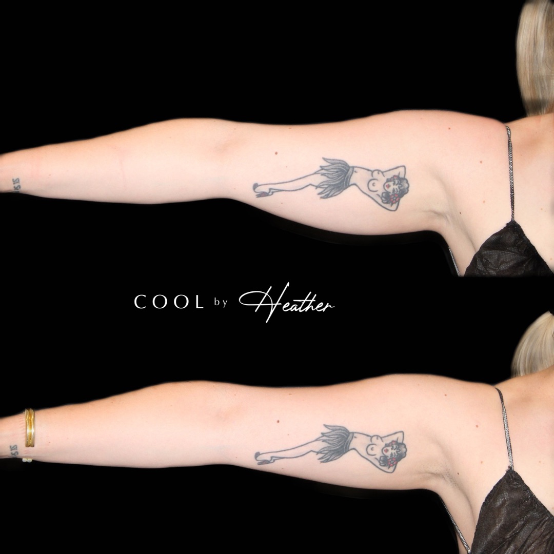 An arm of woman before and after treatment