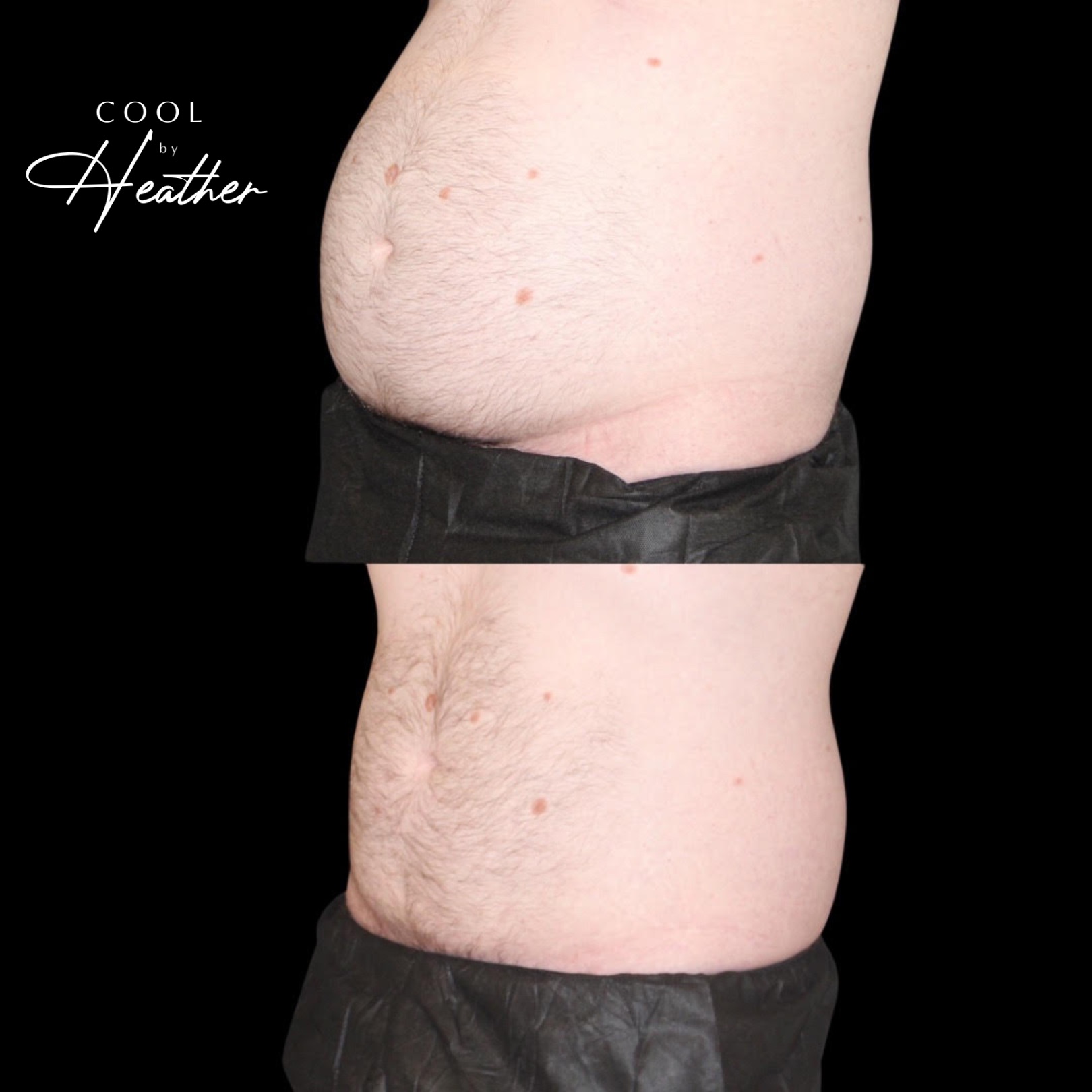 Before and after Coolsculpting treatment showing a big difference in the fat volume of a man's belly, a service offered at Haus of Aesthetics in Salt Lake City, Utah.