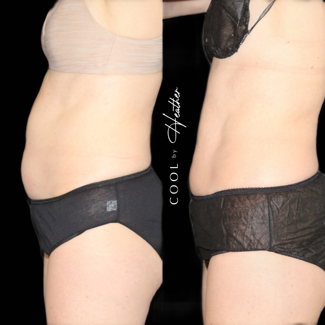 An abdomen of a woman before and after Coolsculpting treatment, a service offered at Haus of Aesthetics in Salt Lake City, Utah.