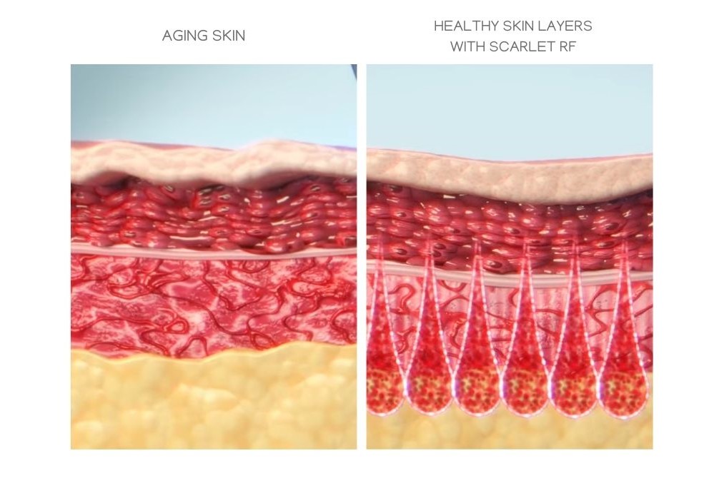 Comparison of a healthy skin layers treated with Scarlet SRF microneedling vs. untreated skin