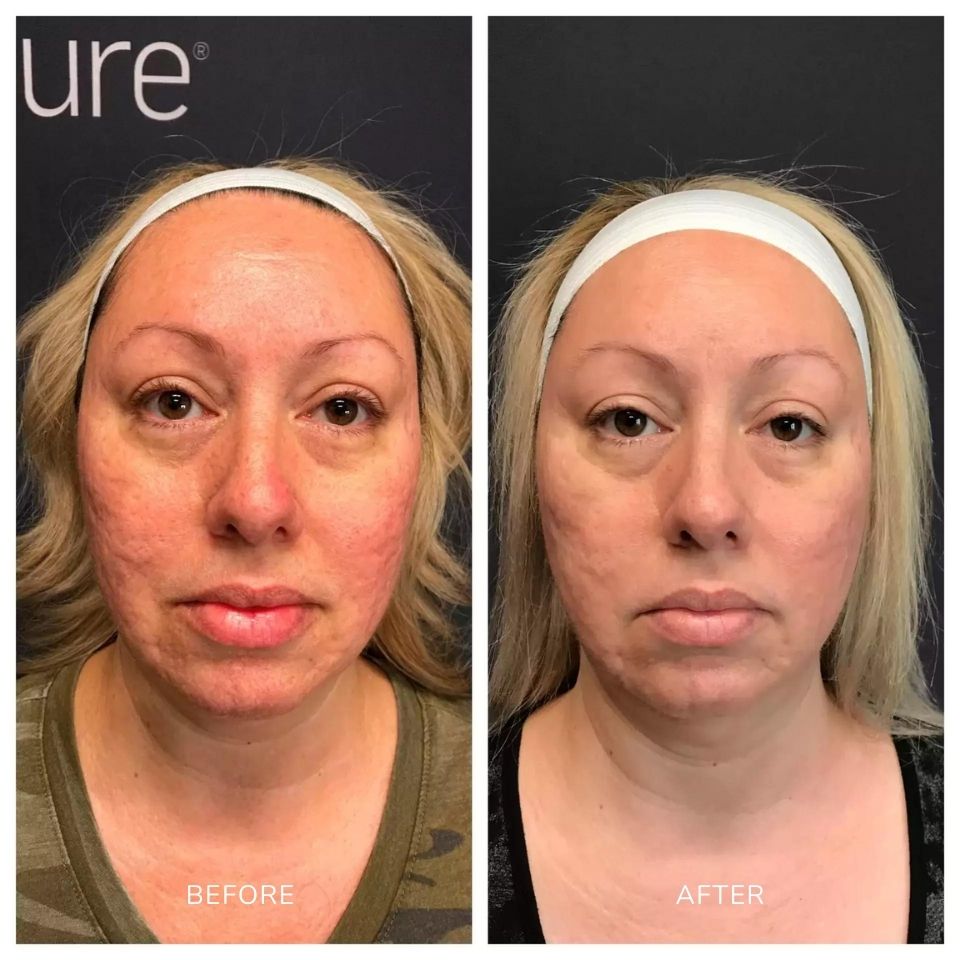 Before and after images of a woman treated with scarlet SRF microneedling on the face area