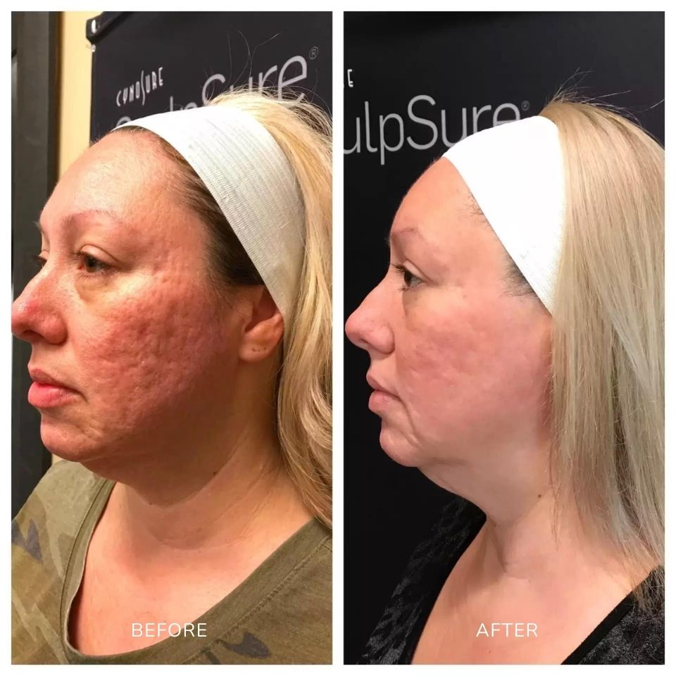 before and after photos of a woman treated with scarlet SRF microneedling on her face area