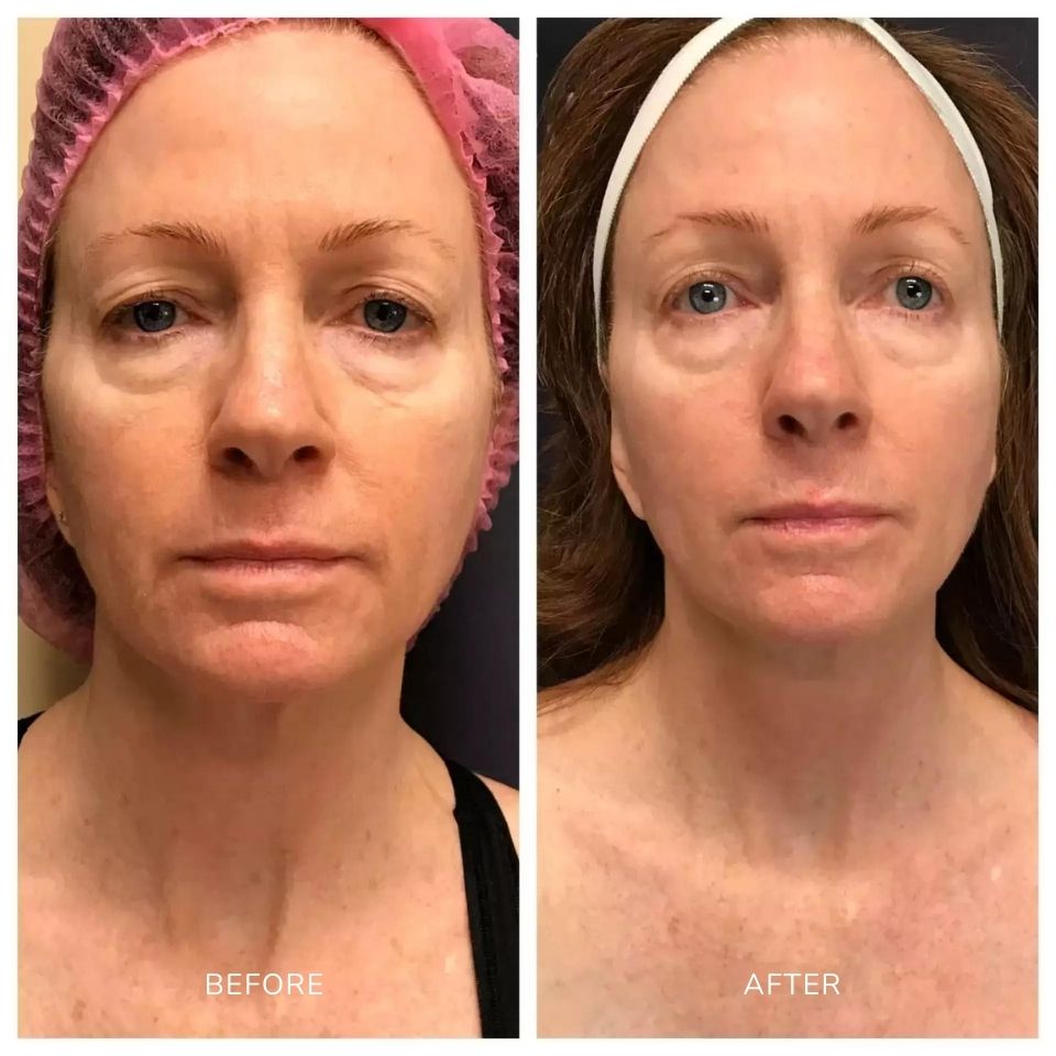 Pictures of a female treated with scarlet SRF microneedling on the skin area in Salt Lake City, UT.
