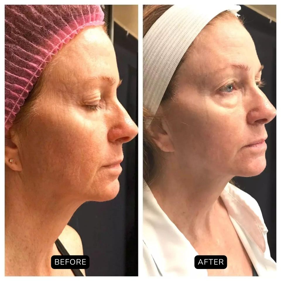 Before and after photos of a female treated with scarlet SRF microneedling on the face in Salt Lake City, UT.