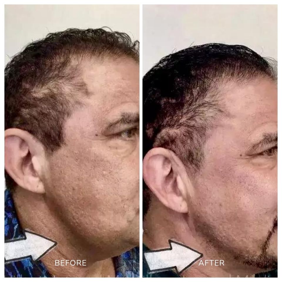 Before and after photos of a male treated with scarlet SRF microneedling on the neck area in Salt Lake City, UT