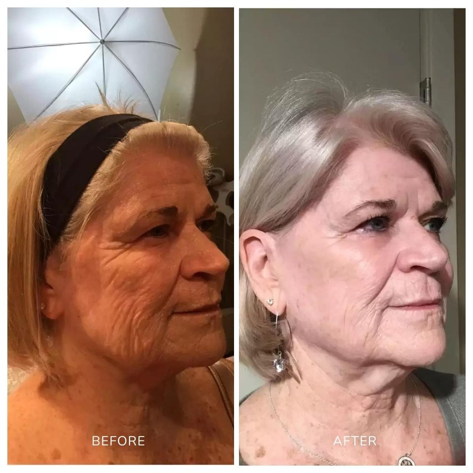 Before and after photos of a woman treated with scarlet SRF microneedling on the cheek area in Salt Lake City, UT