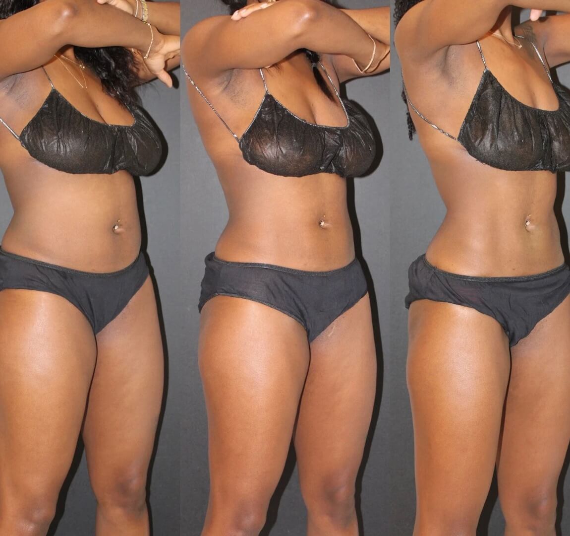 Weight Loss Injections-and-Coolsculpting-Elite-before-and-after-photos-Haus-of-Aesthetics-Salt-Lake-City-UT-Real-patient